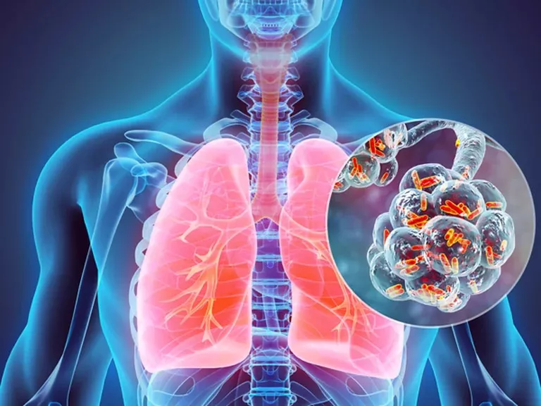 Neumonía_Tucumán_1