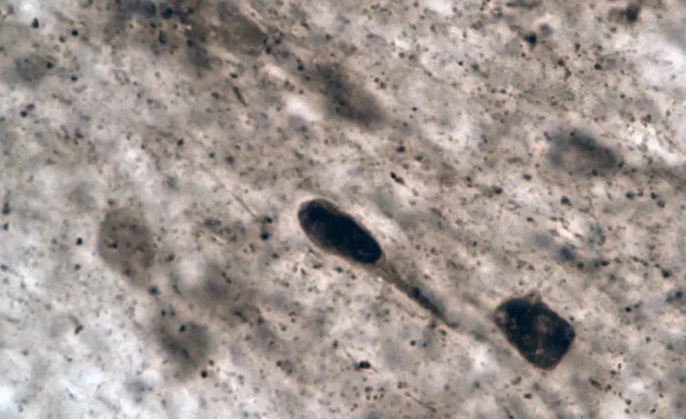 Parkinson_2