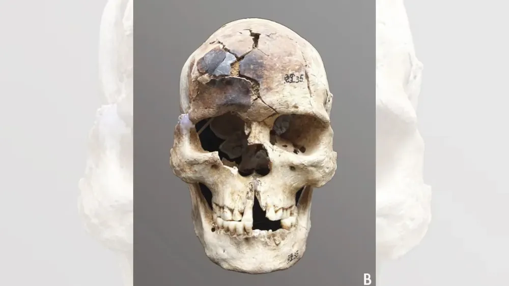 el-craneo-de-una-momia-hallada-en-china-con-marcas-de-quemaduras-foto-li-zhen-y-hirofumi-matsumuraap-VRWJQGM5TZGSNLCSRGIHSG27OY