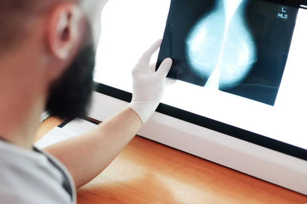 cáncer de mama en hombres 1