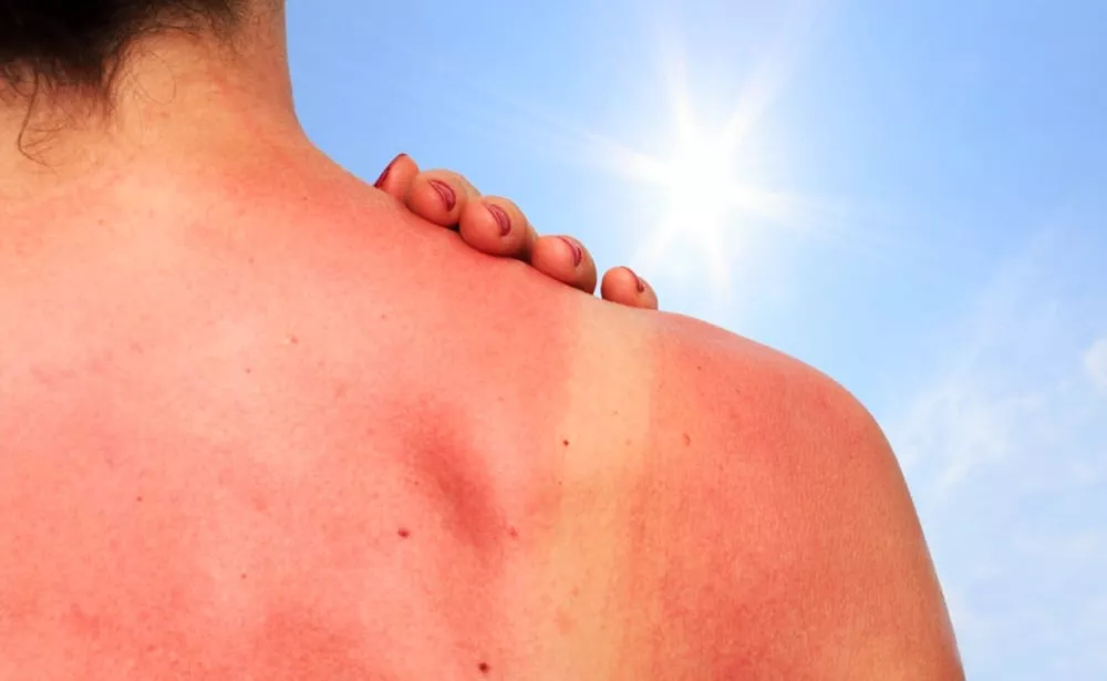 exposicion-al-sol-cancer-de-piel