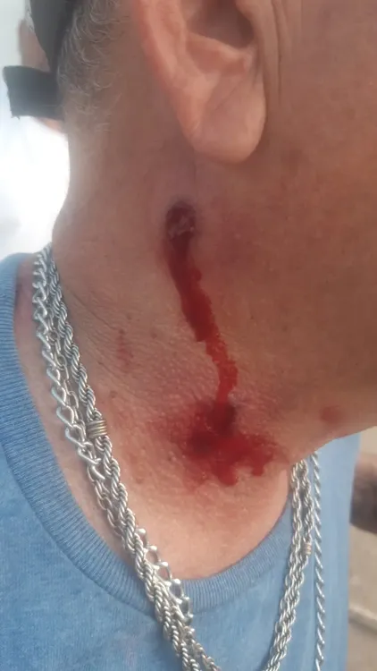 HERIDO DE BALA