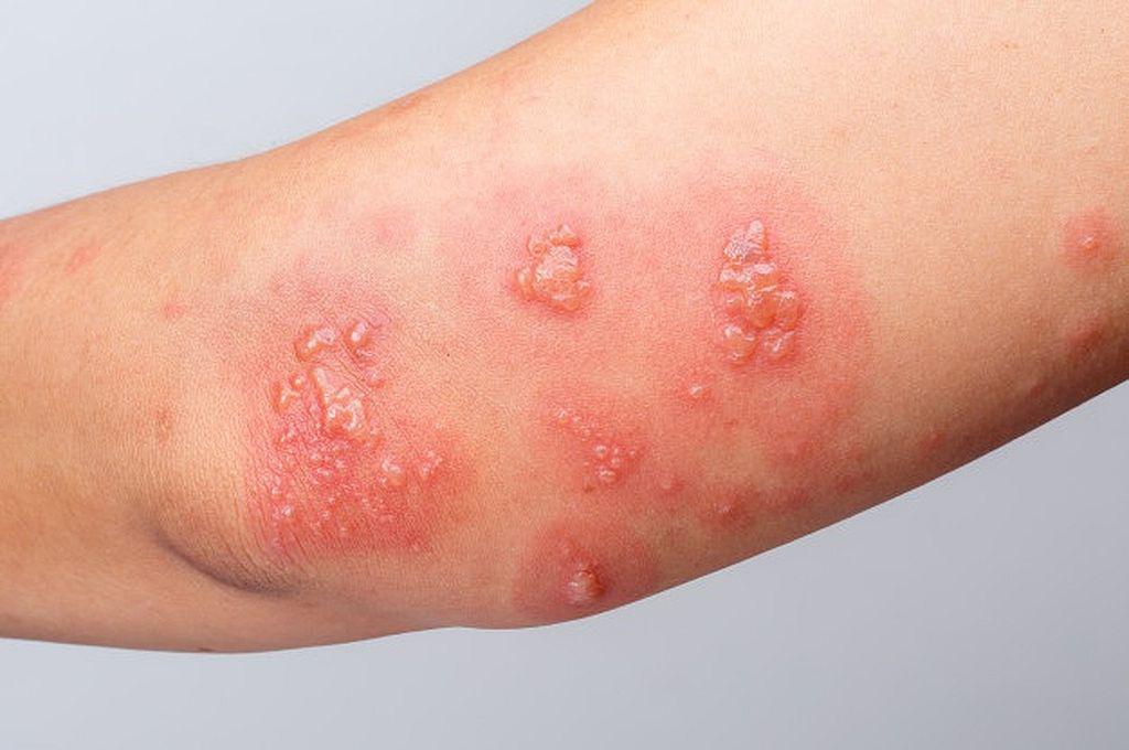 herpes