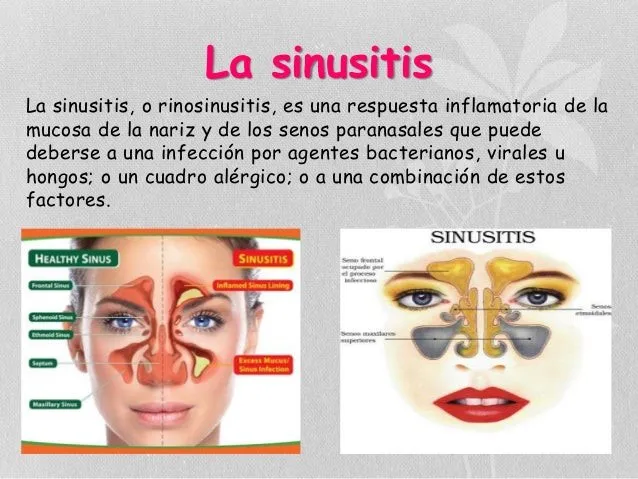 sinusitis