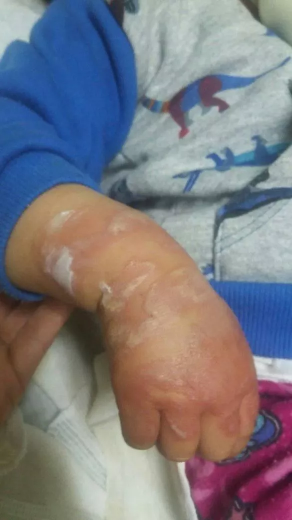 QUEMADURAS MENOR DE EDAD