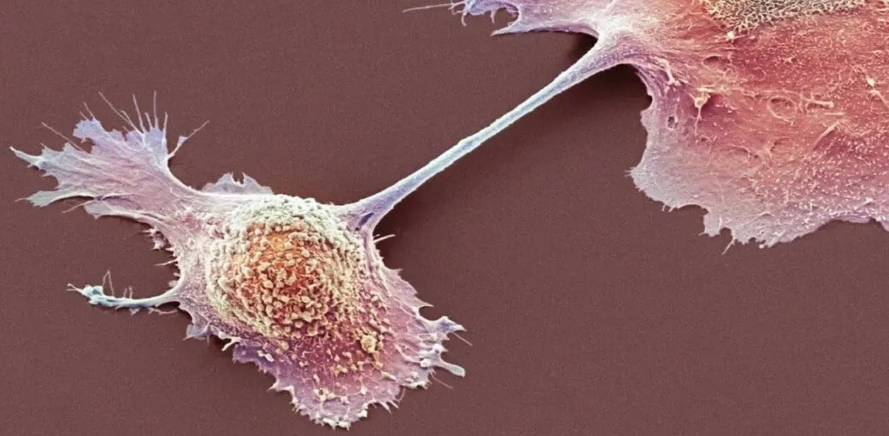 Cáncer de páncreas_1